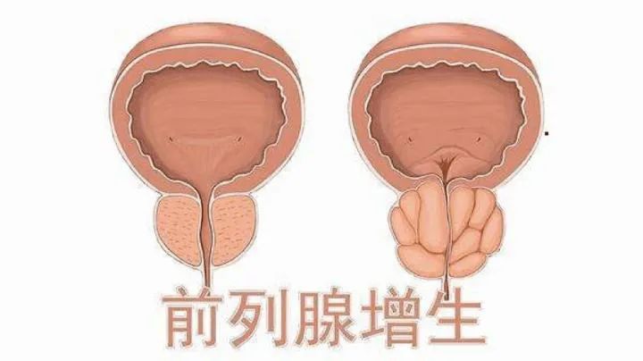 糖尿病出现尿路感染？不要慌