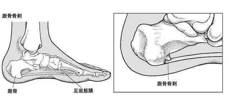 骨刺不是病？切勿过度治疗！