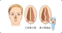 90%的人都患有鼻中隔偏曲，什么情况下需要手术？